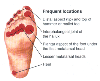 open sore on heel of foot